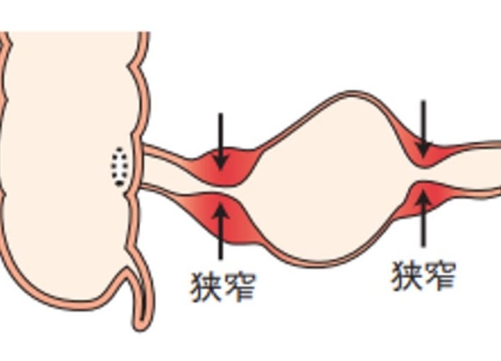 子供のクローン病の症状は何ですか?